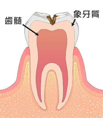 C2（中程度）虫歯